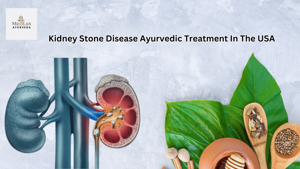 Kidney Stone Disease Ayurvedic Treatment in the USA