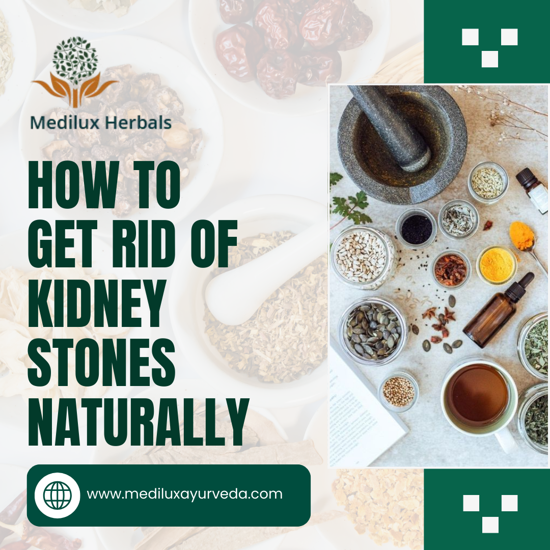 How to Get Rid of Kidney Stones Naturally